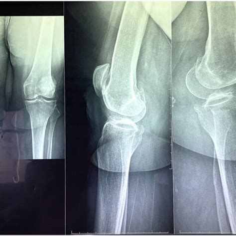 Right Knee And Left Knee X Rays Before Surgery Download Scientific