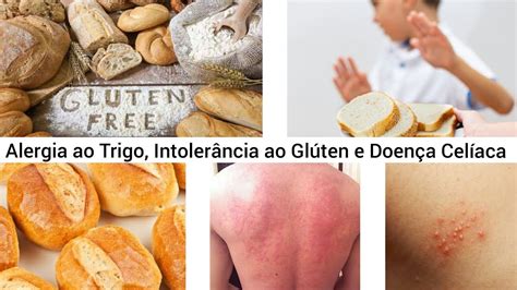 Como Saber Se Tem Intolerância A Glúten - Alergia ao Trigo X Intolerância ao Glúten X Doença Celíaca - YouTube
