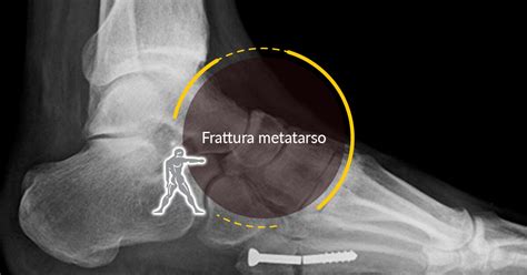 Frattura Metatarso Cos è e come si cura Ryakos Center