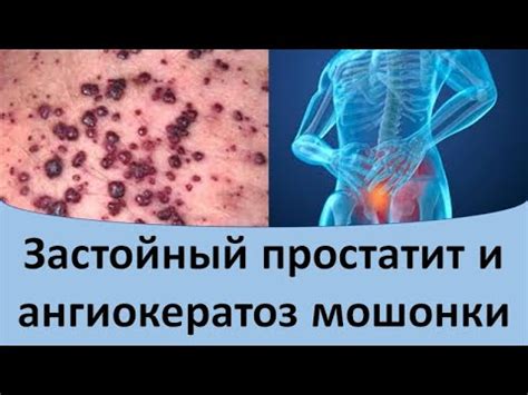 Застойный простатит и ангиокератоз мошонки - YouTube