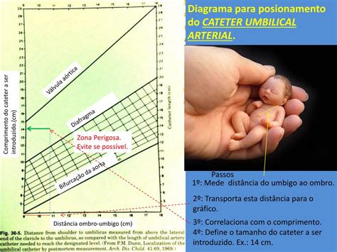 Qual Cateter Fura O Umbigo - PPT - POSICIONAMENTO DE CATETER UMBILICAL PowerPoint Presentation, free ...