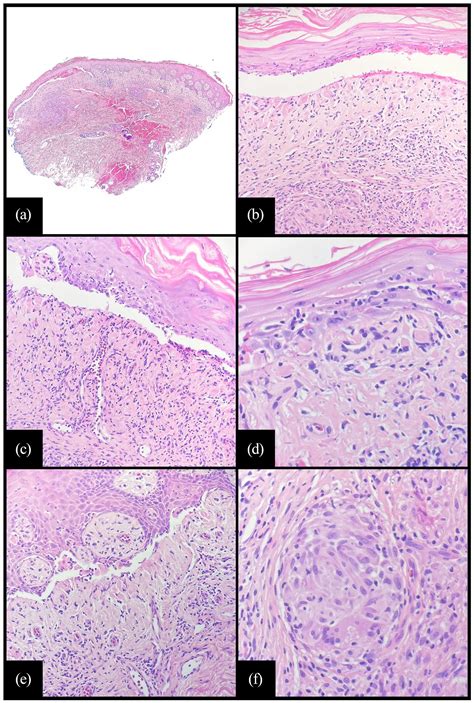 Lichenoid Granulomatous Dermatitis A Case With Dramatic Desquamation