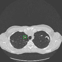 Lung Nodule Segmentation Study Instance Segmentation Dataset By Varun