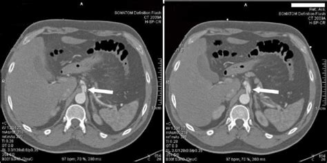 Upper abdominal contrast-enhanced CT scan revealed celiac artery dissection | Download ...