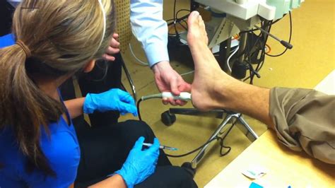 Ultrasound Treatment For Plantar Fasciitis Ultrasound Guided