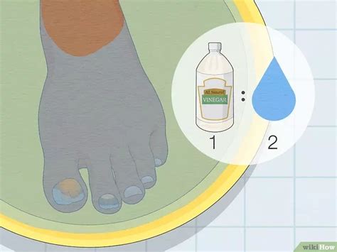 How to treat toenail fungus effective remedies prevention – Artofit