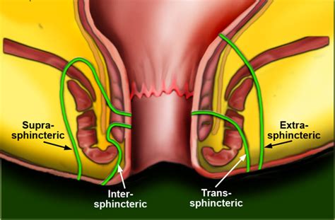 Enfermedades De Ano Y Recto Coloclinic