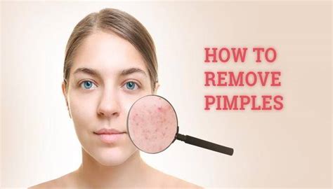 मुंहासे पिंपल हटाने के 20 घरेलू उपाय How To Remove Pimples