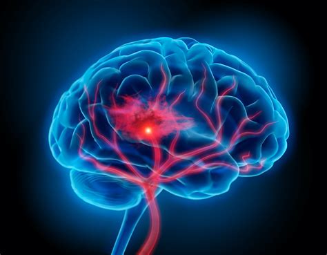 Intracerebral Hemorrhage Management - University Hospitals