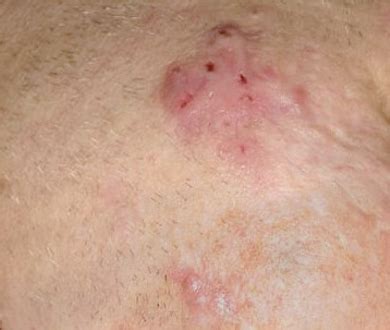 Keloid and Hypertrophic Scars - acne support