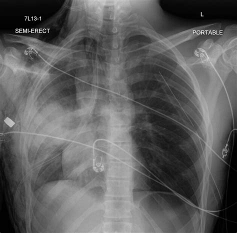 Lung Contusions Pacs