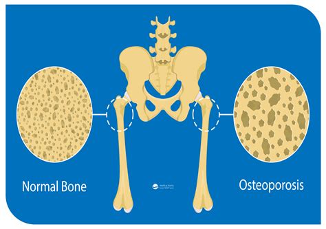 Osteoporosis - Health and Vitality Center | Dr. Shiva Lalezar