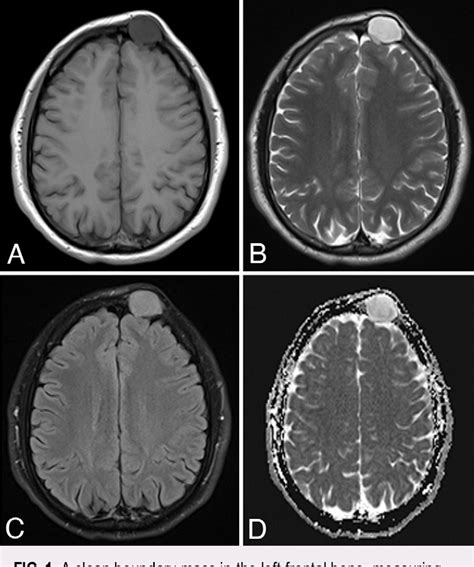 Figure From Primary Microcystic Reticular Schwannoma Of The Frontal