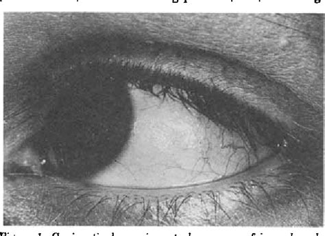 Figure 1 from Conjunctival Xerosis in Cystic Fibrosis | Semantic Scholar