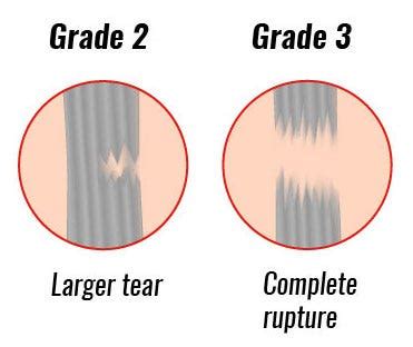 What Is The Best Ligament Knee Brace For Me? Ultimate Guide for ACL ...