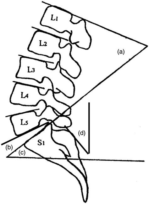 Method Of Measurement Of Parameters A Angle Of Lomber Lordosis B