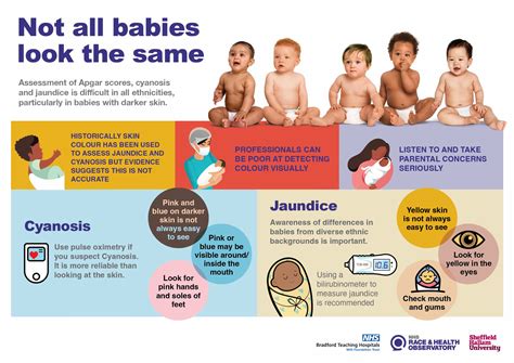 how to help jaundice baby at home