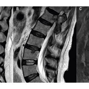 Spine MRI A B Sagittal T2 Weighted Dixon In Phase And Axial T1