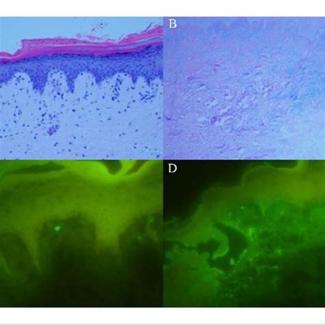 Skin Biopsy Indicates Subacute Lupus Erythematosus A Sporadic