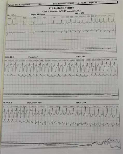 AICD Procedure & Case Study - Kauvery Hospital’s Approach to Automatic