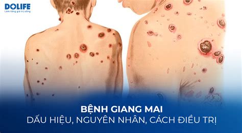Bệnh Giang Mai Dấu Hiệu Nguyên Nhân Cách điều Trị Bệnh Viện Quốc