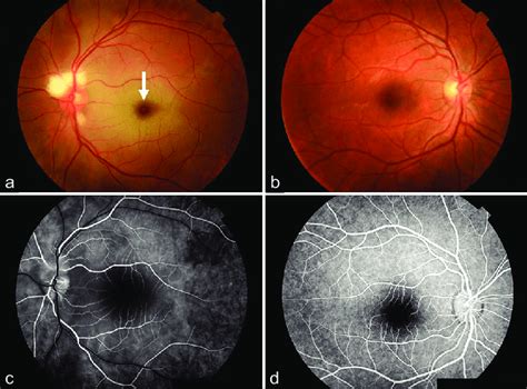 Retinography Fundus Photography On The Nd Postoperative Day Of Both