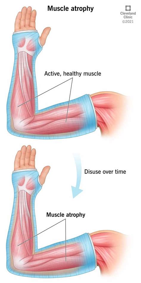 Muscle atrophy – Artofit