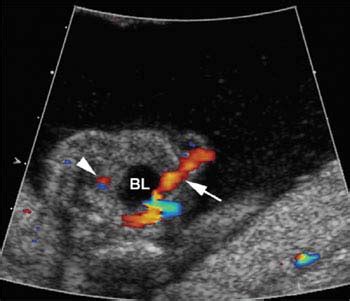 Umbilical Cord | Radiology Key