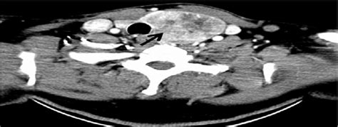 intravenous contrast ct scan   neck showed  left thyroid lobe