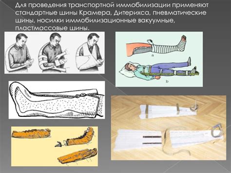 Транспортная иммобилизация.Правила наложения транспортных шин