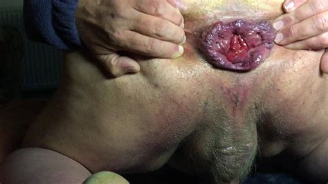 Six Anal Gapes With Ice Block Gay Amateur Amateur Porn XHamster