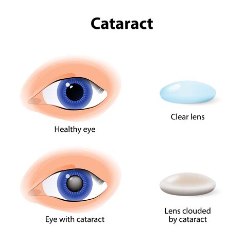 What Are Cataracts? - What Are Cataracts?