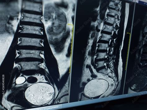 X Ray Image Two Views Mri Lumbar Spine Showing Herniated Nucleus