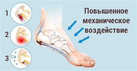 Пяточная шпора: самое эффективное средство для снятия воспаления и боли!