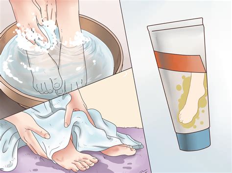 How to Treat Calluses – Mytour