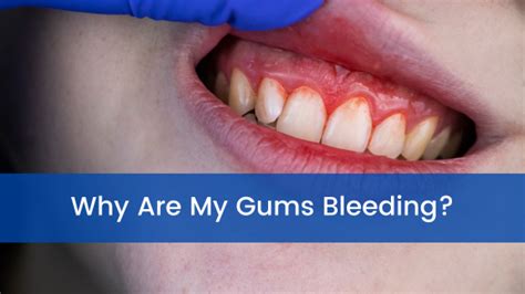 Why Are My Gums Bleeding Dorothy Paul Dds