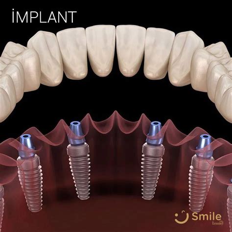 Zmir Mplant Tedavisi Mplant Fiyatlar Smile Zmir