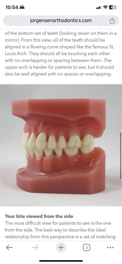Fixing Posterior Open Bite Advocacyprogress Rinvisalign