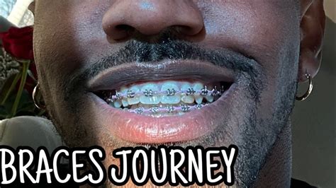 Embracing The End The Final Chapter Of My Braces Journey” Youtube