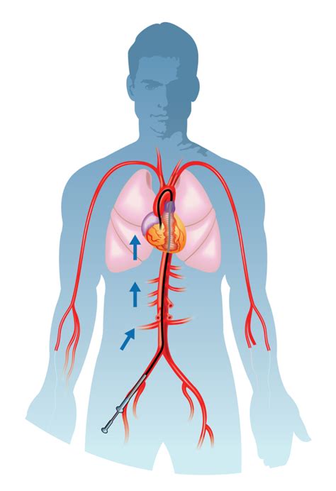 Coronary Angiogram/Angioplasty Pre-procedure guide - CVSKL