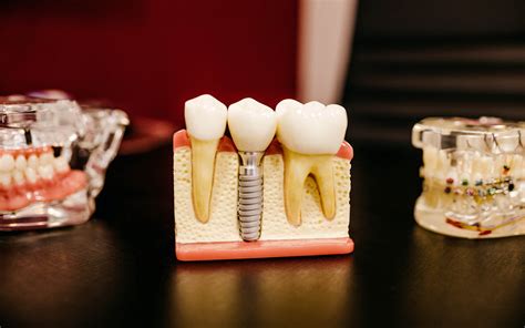 6 Dental Implants Caring Tips District Dentistry