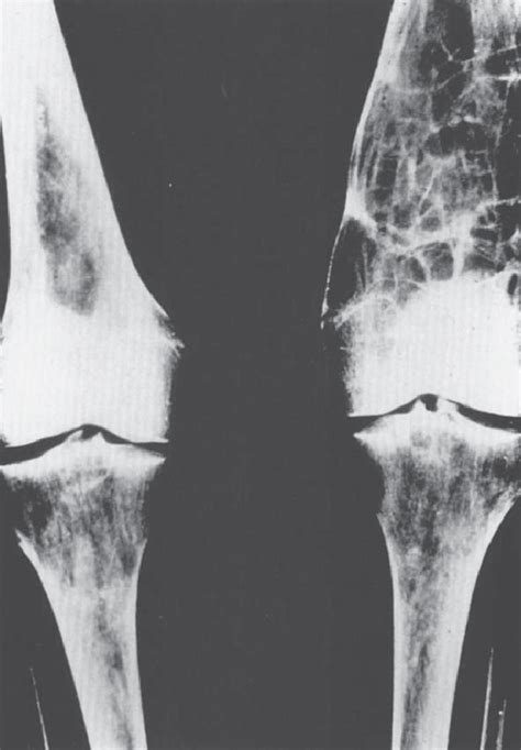 Gaucher disease. Radiograph of lower extremities showing Erlenmeyer... | Download Scientific Diagram