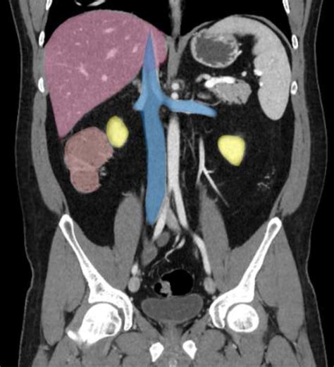 Coronal Ct Abdomen Xxii Diagram Quizlet