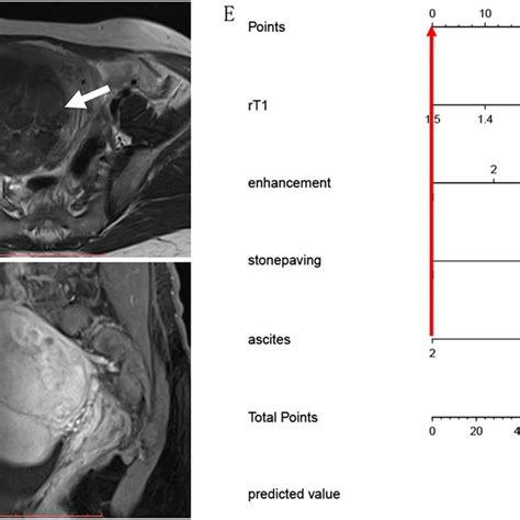 A 43 Year Old Woman With A Blm A Axial T1 Weighted Imaging Shows A Download Scientific