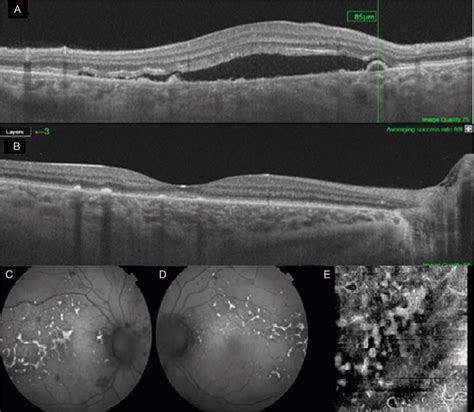 Multimodal Imaging Of Hypertensive Chorioretinopathy By Swep Medicine