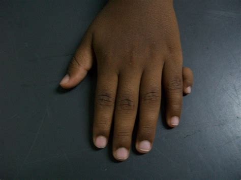 File:Polydactyly Left Hand.jpg - Wikimedia Commons