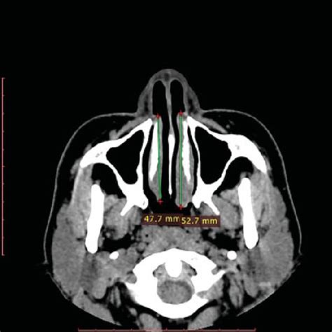 Pdf Computed Tomography Measurement Of Inferior Turbinate In