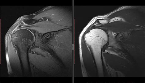 Shoulder Impingement MRI