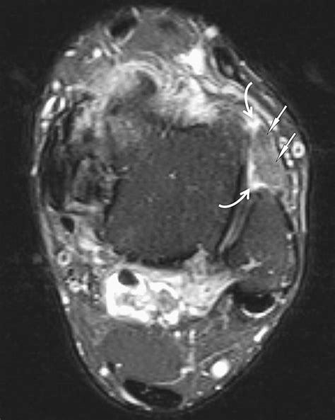 Impingement Syndromes Of The Ankle Magnetic Resonance Imaging Clinics