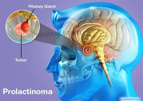 What Is A Prolactinoma And How Can It Affect A Persons Sexual Function